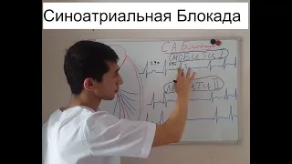 Синоатриальная Блокада на ЭКГ.Нарушение проводимости.