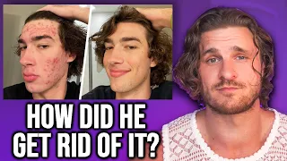 My Struggles With Acne... | HOW HE GOT RID OF IT (REACTION)