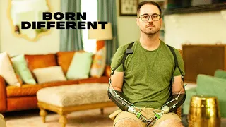 My Hands Were Crushed In A Metal Rolling Machine | BORN DIFFERENT