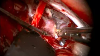 Far-lat. transcondylar approach for microsurgical trapping of AICA aneurysm