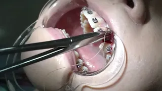 Отрытие ретинированного зуба | брекеты самара