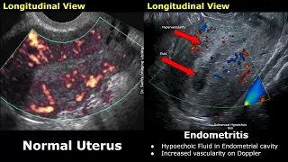 Uterus & Adnexa Ultrasound Normal Vs Pelvic Inflammatory Disease (PID) Images | Gynecological USG