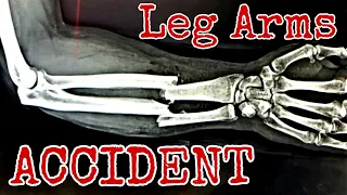 Leg Arms "Arm" Crushed｜How It Happened