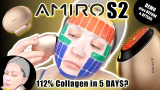 AMIRO S2 Facial RF Skin Tightening Device | DEMO W/ BEFORE & AFTER RESULTS