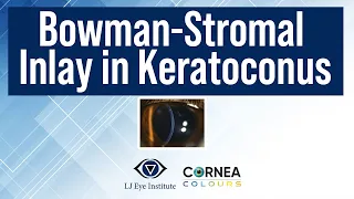 BOWMAN-STROMAL INLAY IN KERATOCONUS | Cornea Colours | Season-2