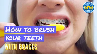 How to Brush with Braces? - 3 Brushing Tips