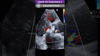 Hands-on Experience 2: CW Ao in PLAX, LVOT measurement, AAA, …
