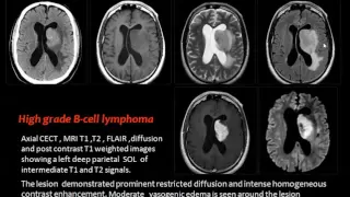 Imaging of Lymphoma I   DRE 3   Dr  Mamdouh Mahfouz