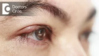Do swollen, itchy & burning eyes indicates Blepharitis? - Dr. Sunita Rana Agarwal