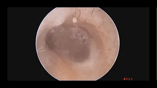 Cleaning Infected Mastoidectomy Cavity