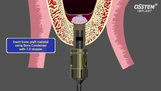 Internal Sinus Lift