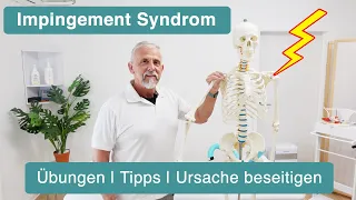 Impingement Syndrom Schulter ✅ Übungen | Tipps | Lösung