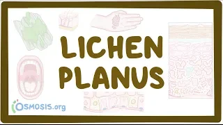 Lichen planus - causes, symptoms, diagnosis, treatment, pathology