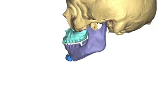 IMDO-LeFort jaw surgery explained