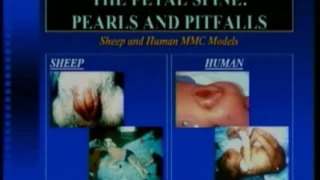 The Fetal Spine Pearls & Pitfalls