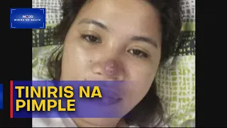 Mukha ng Balita | Tiniris na pimple sa ilong, nagdulot ng iba't ibang sakit