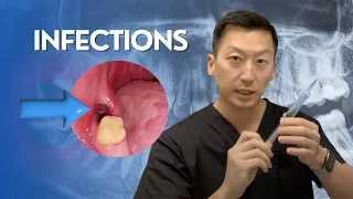 Infections after Wisdom Teeth Removal