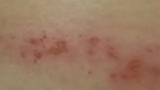 Scabies mystery solved?