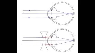 Refractive Errors - Hyperopia, Myopia, Astigmatism, Accommodation & Presbyopia