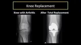 Understanding Knee Arthritis, Partial and Total Knee Replacement