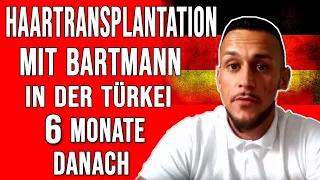 Haartransplantation mit Bartmann in der Türkei - 6 Monate danach