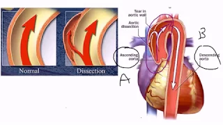 Aortic Dissection