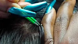 ASMR | Nitpicking Whiteheads With Tweezers, Parting with a wooden African comb