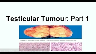 Seminoma: Clinical picture, Morphology and staging