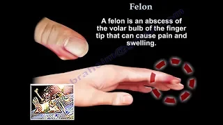 Felon - Everything You Need To Know - Dr. Nabil Ebraheim