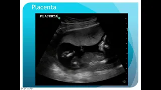 M4 Surgical Skills POCUS in 2nd and 3rd Trimester Pregnancy