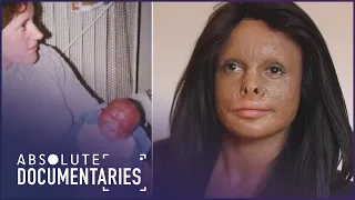 Did My Mother Set Me On Fire As A Baby?! | Annie: Out Of The Ashes | Absolute Documentaries