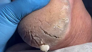 Super thick dead skin! Thoroughly clean the soles of the feet【Pedicure Master Lin Jun】