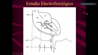 Bradiarritmias