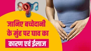 बच्चेदानी के मुंह पर घाव का कारण एवं ईलाज | Uterus Ulcer Symptoms in Hindi | Dr Sushila Saini