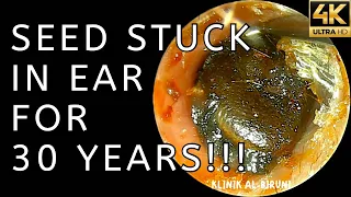 Huge Seed Stuck In Ear For 30 YEARS!!! (4K 60FPS)