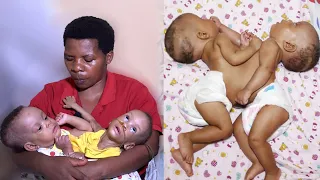 One Of Our Conjoined Twins Is Dying : THIS VIDEO WILL MAKE YOU CRY