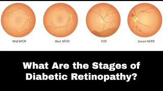 What Are the Stages of Diabetic Retinopathy ?