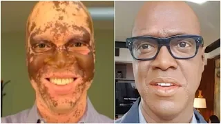 TV Reporter Paints His Skin Every Day To Save His Career