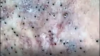 Blackheads removal from face - blackhead removal - acne 2019