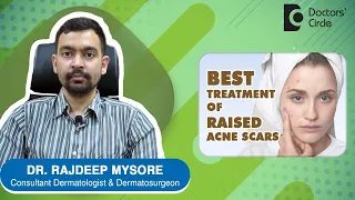 How to treat raised acne scars? - Dr. Rajdeep Mysore | Doctors' Circle