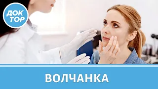 Как жить с системной красной волчанкой