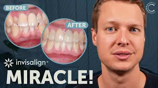 Impossible Smile Transformation Solved with Invisalign - Full Case Study