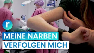 Meine Selbstverletzung ist Vergangenheit! Ich entferne meine Narben | reporter