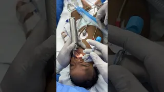 Intubating a cleft kid @ Richardsons by our pediatric cardiac anesthesiologist and his team