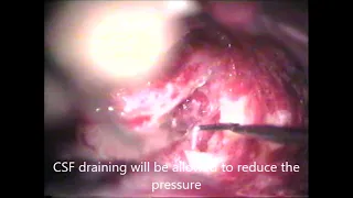 Transmastoid + translabyrinthine total facial nerve decompression