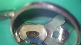 Maxillary 2nd premolar with 3 Canals - Трёхканальный премоляр 1.5