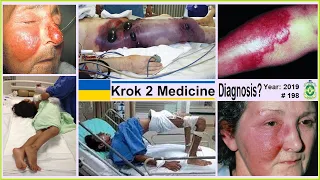 [ Krok 2 Medicine ] Year: 2019 - 198 (Ministry of Public Health of Ukraine)