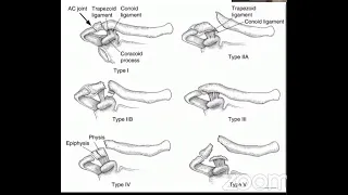 Lateral-end Clavicle Fractures