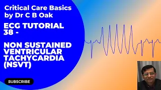 ECG Tutorial 38 Non sustained Ventricular Tachycardia