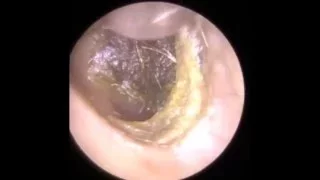 Endoscopic Ear Wax Removal Leicester - The Hear Clinic